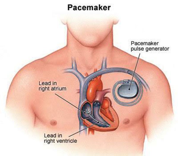 pacemaker-doctor-manish-kumar-sharma