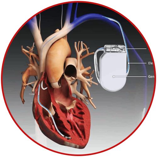 aicd-implantation-in-delhi